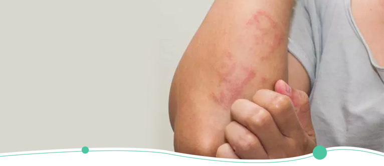 Scabies